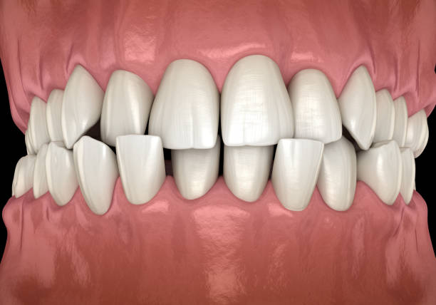 anterior crossbite zahnverschluss ( maloklusion der zähne ). medizinisch genaue zahn-3d-illustration - fehlbiss stock-fotos und bilder