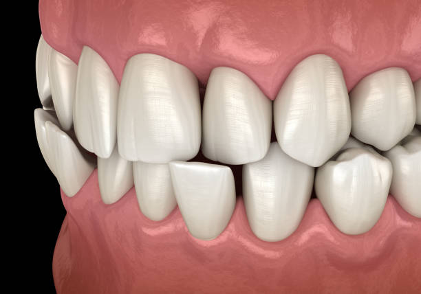 istock Anterior crossbite dental occlusion ( Malocclusion of teeth ). Medically accurate tooth 3D illustration 1221090994