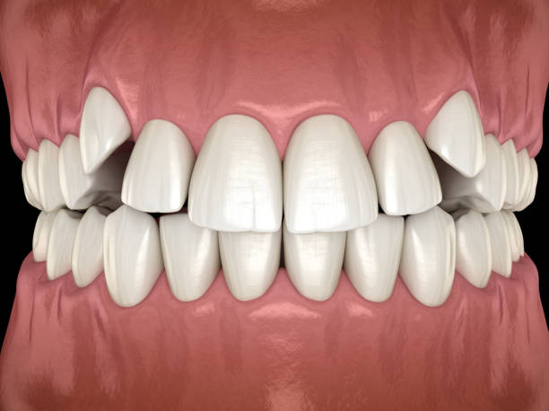 istock Impacted incisors, overcrowded teeth. Medically accurate 3D illustration of abnormal dental occlusion 1221090996