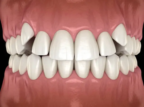 Impacted incisors, overcrowded teeth. Medically accurate 3D illustration of abnormal dental occlusion