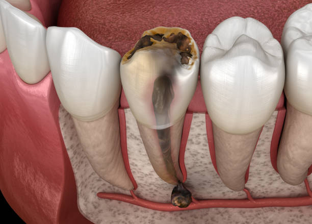 istock Periostitis tooth - Lump on Gum Above Tooth. Medically accurate dental 3D illustration 1221091004