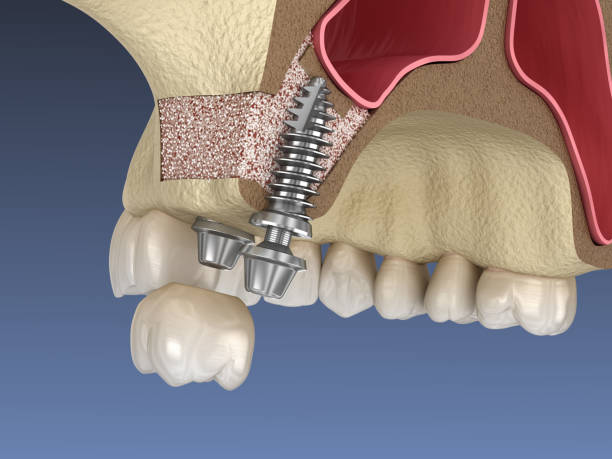 sinus lift surgery - implant installation. 3d illustration - implantat imagens e fotografias de stock