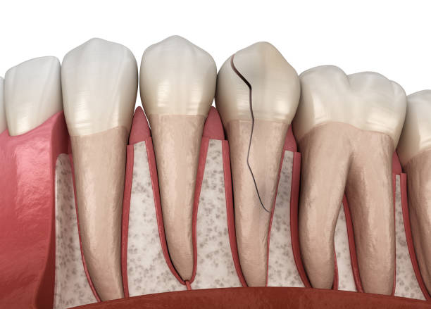 istock Cracked tooth, splitted. Medically accurate 3D illustration 1221091041