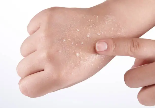 Photo of I rubbed the back of my hand to get dead skin cells.