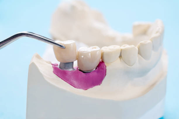 istock Implant Prosthodontics or Prosthetic 1221294342