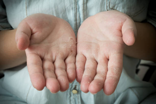 istock Dermatitis. Dry, flaky and peeling fingers on hand. 1221317822