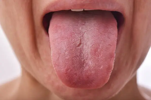 Photo of Tongue problem disease, Fissured white tongue, Unhealthy oral care hygiene.