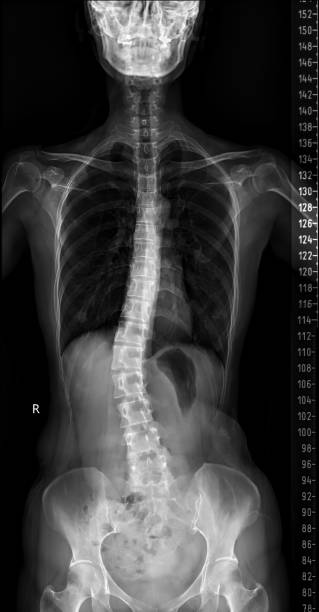 キャリブレーションツールで暗い背景の背骨全体のx線。 - pain rib cage x ray image chest ストックフォトと画像