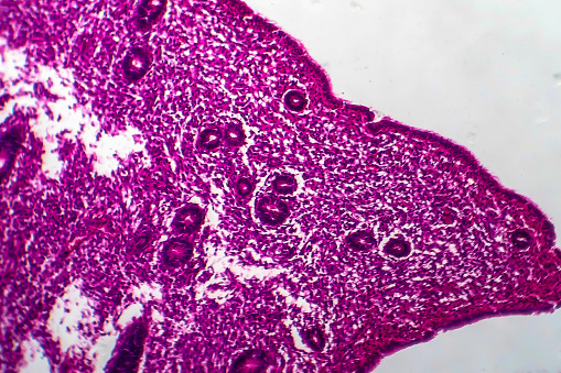 Endometrial hyperplasia, light micrograph, photo under microscope