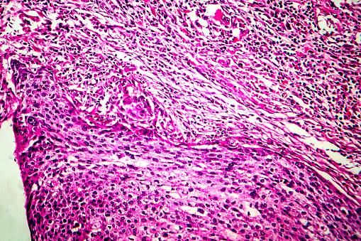 Squamous cell carcinoma of the uterus, light micrograph, photo under microscope