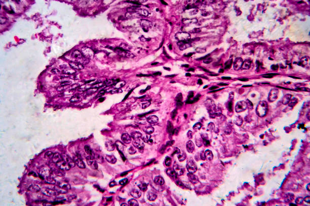 adenometrial adenocarcinoma, micrografo leve - endometrial adenocarcinoma - fotografias e filmes do acervo