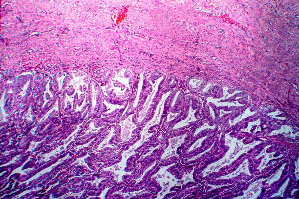 Endometrial adenocarcinoma, light micrograph Endometrial adenocarcinoma, light micrograph, photo under microscope adenocarcinoma photos stock pictures, royalty-free photos & images