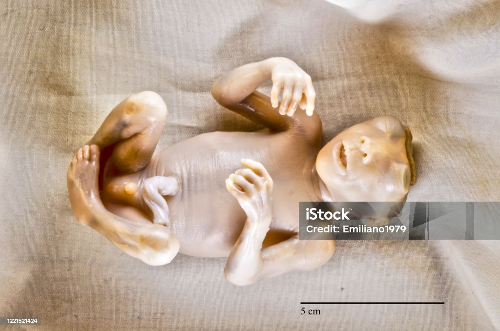 Anencephaly 17 week old male human fetus with anencephaly, ventral view. Autopsy Stock Photo