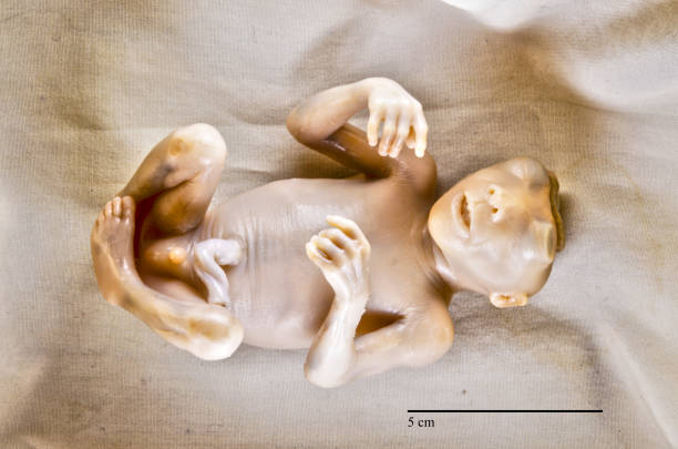 Anencephaly 17 week old male human fetus with anencephaly, ventral view. central nervous system photos stock pictures, royalty-free photos & images