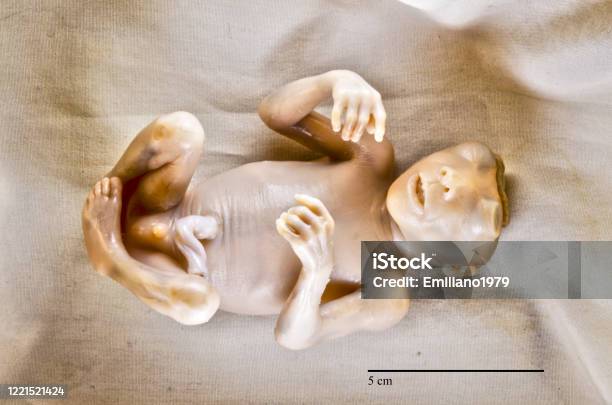 Anencephaly Stock Photo - Download Image Now - Autopsy, 17 Week Foetus, Abdomen