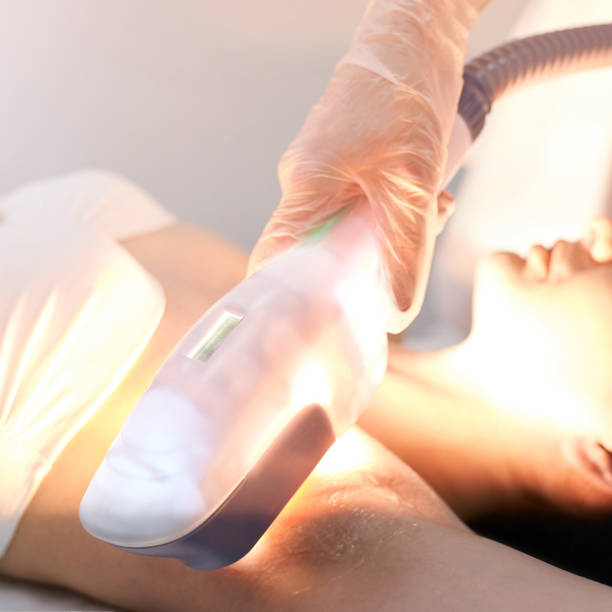 dispositivo medico elos laser. rimuovere capelli e asterik indesiderati. procedura di cosmetologia spa al salone. epilazione amprit - dermatology dermabrasion surgery medical foto e immagini stock