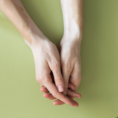 Close up of female hands with vitiligo pigments on green background.