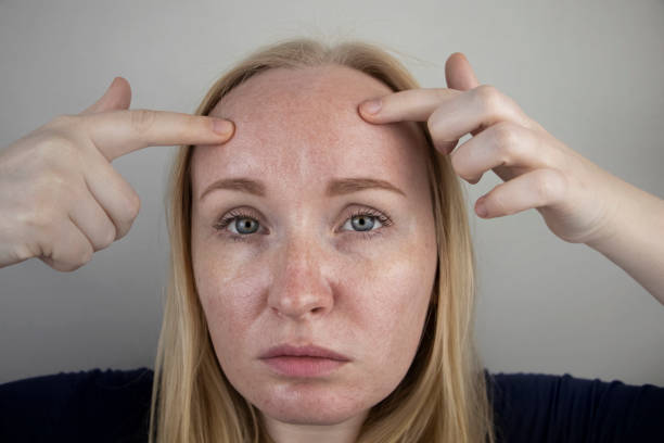 Oily and problem skin. Portrait of a blonde girl with acne, oily skin and pigmentation stock photo