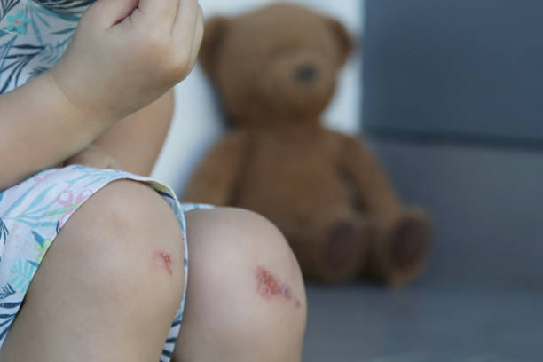 una niña sentada afuera sola con su peluche. rodillas y piernas infantiles cubiertas de arañazos y moretones. - child physical injury teddy bear wound fotografías e imágenes de stock