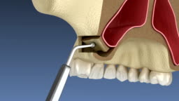 Sinus Lift Surgery With Lateral Access 3d Animation Of Dental Surgery Stock Video - Download Video Clip Now - iStock Sinus Lift Surgery With Lateral Access 3d Animation Of Dental Surgery Stock Video - Download Video Clip Now - iStock