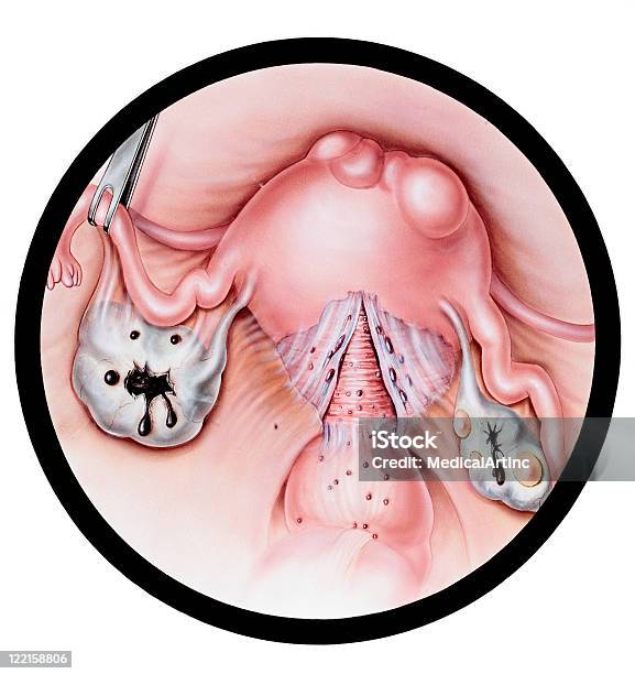 Macicaendometrioza - Stockowe grafiki wektorowe i więcej obrazów Endometrioza - Endometrioza, Macica, Menopauza