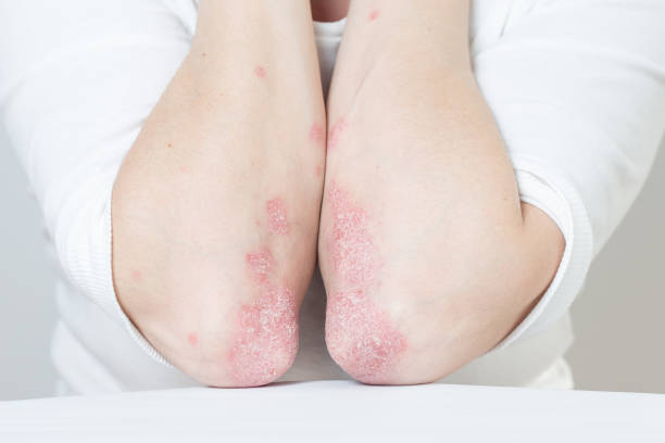 Acute psoriasis on the elbows is an autoimmune incurable dermatological skin disease. Large red, inflamed, flaky rash on the knees. Joints affected by psoriatic arthritis Acute psoriasis on the elbows is an autoimmune incurable dermatological skin disease. Large red, inflamed, flaky rash on the knees. Joints affected by psoriatic arthritis skin inflammation stock pictures, royalty-free photos & images