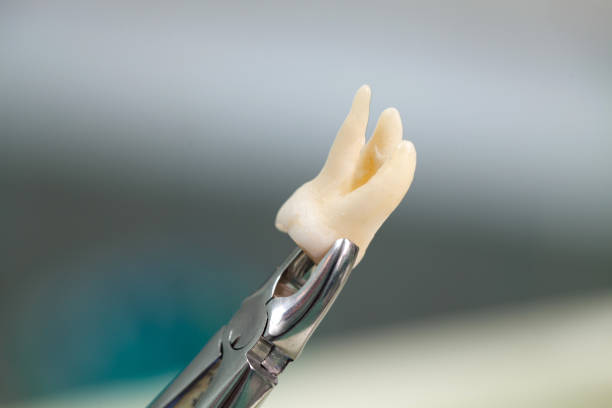 Extracted tooth stock photo