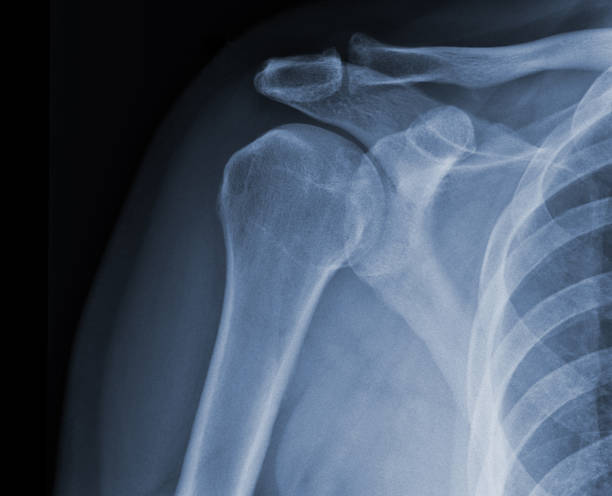 x-ray shoulder radiograph show state of injury - x ray x ray image shoulder human arm imagens e fotografias de stock
