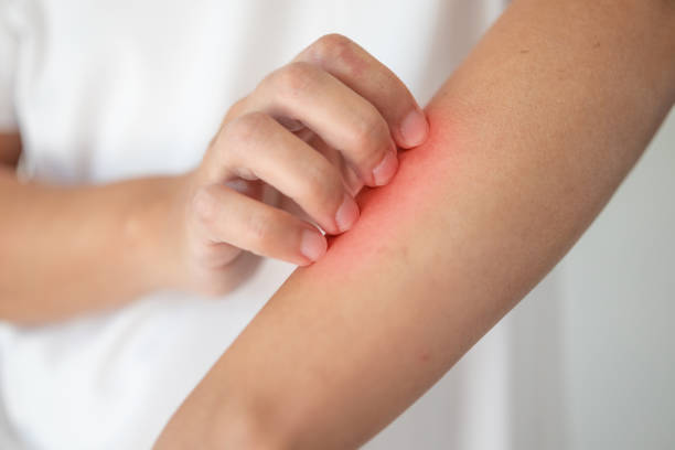 istock man itching and scratching on arm from itchy dry skin eczema dermatitis 1221892836