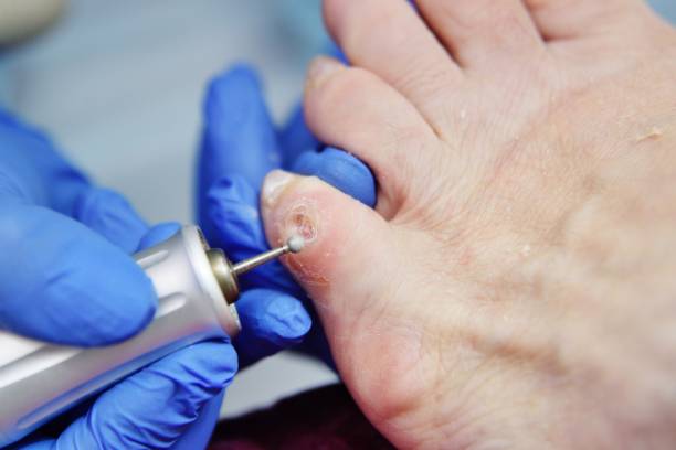 excision of calluses on the toe with a pedicure machine stock photo