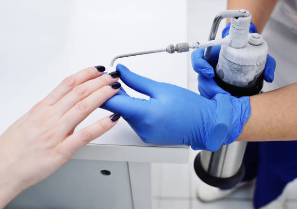 Removal of papillomas and warts on the hand with liquid nitrogen in a special device with a probe - cryodestructors stock photo
