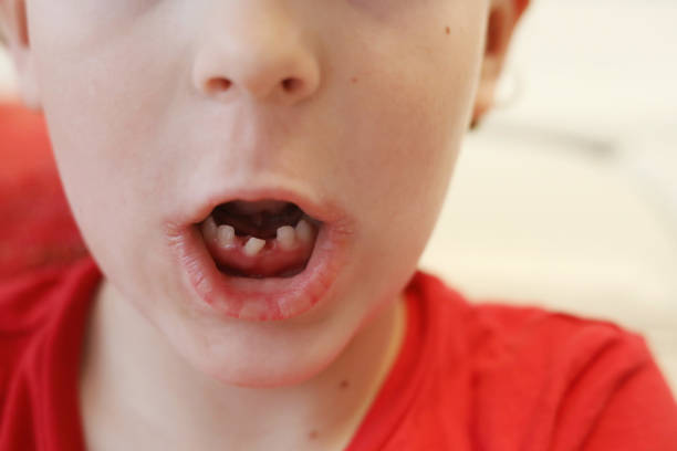 istock Little boy loose and crooked tooth 1221901410