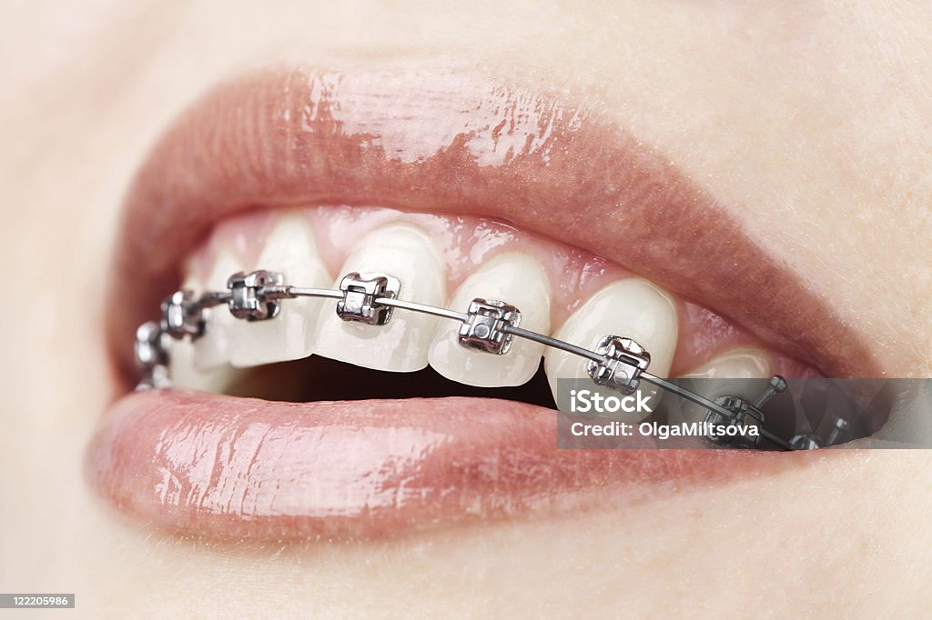 Zähne mit Zahnspange - Lizenzfrei Zahnspange Stock-Foto