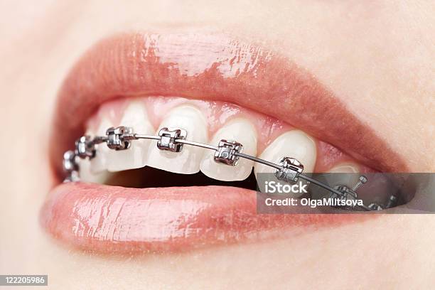 Zähne Mit Zahnspange Stockfoto und mehr Bilder von Zahnspange - Zahnspange, Zahnpflege, Metall