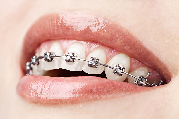 teeth with braces stock photo