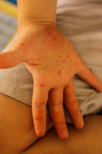 istock Hand foot and mouth 1222165225