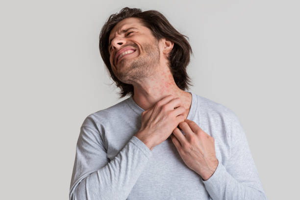 istock Eczema concept. Man suffers from skin irritation 1222193321