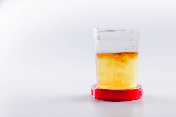 Cloudy or bloody urine sample in sterile plastic container white background with, cloudy or bloody urine Cloudy or bloody urine sample in sterile plastic container on white background with, cloudy or bloody urine urine stock pictures, royalty-free photos & images
