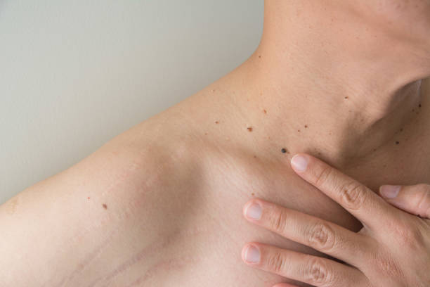 istock Mole on men's skin isolates white background 1222346608