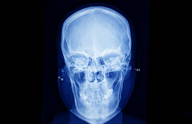 istock X-Ray film of human side view skull bones 1222352812