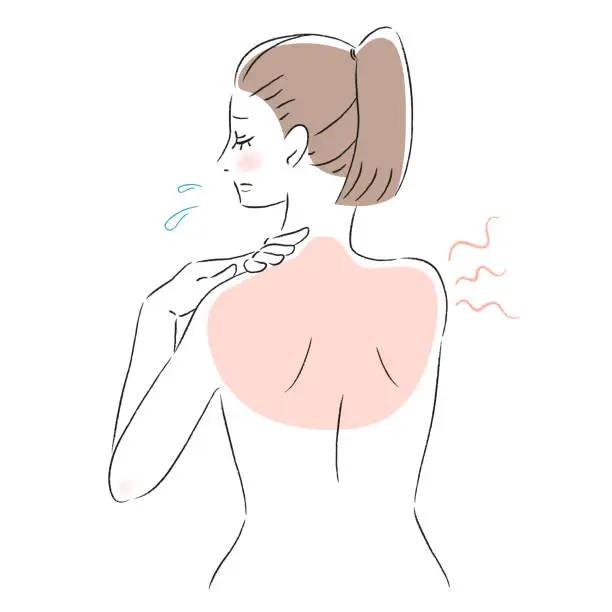 Vector illustration of Illustration of a woman with a sunburned back