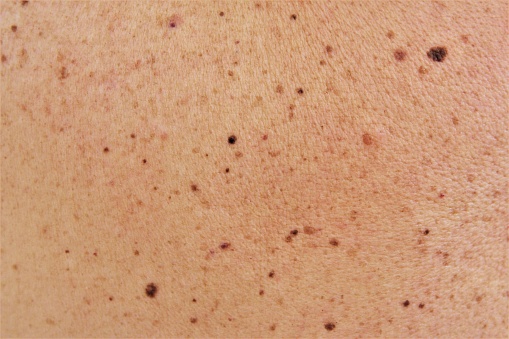 Muchas marcas de nacimiento y lunares en la piel humana.photo photo