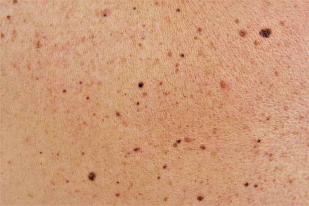 Many birthmark and moles on human skin.photo stock photo