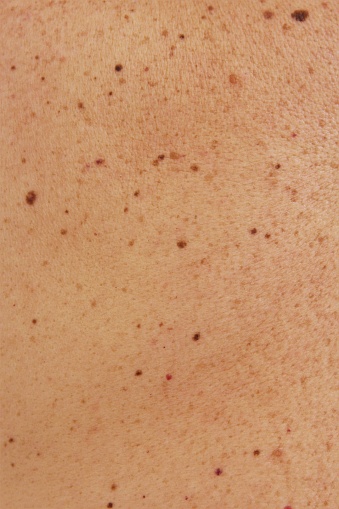 Marcas de nacimiento y lunares en la piel humana. Foto photo