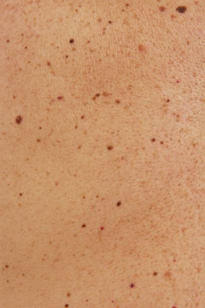 Skin texture black birthmarks and moles on skin of man photo