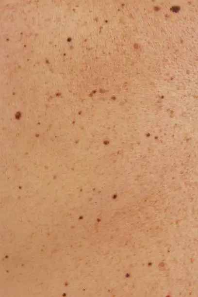 Skin texture black birthmarks and moles on skin of man photo