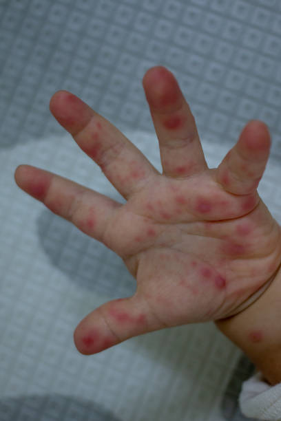 istock Hand Foot and Mouth disease 1222585581