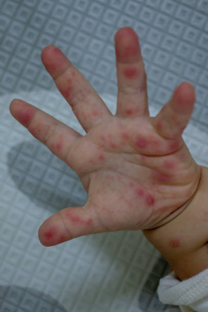 istock Hand Foot and Mouth disease 1222585641