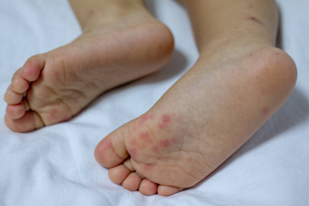 istock Hand Foot and Mouth disease 1222585722