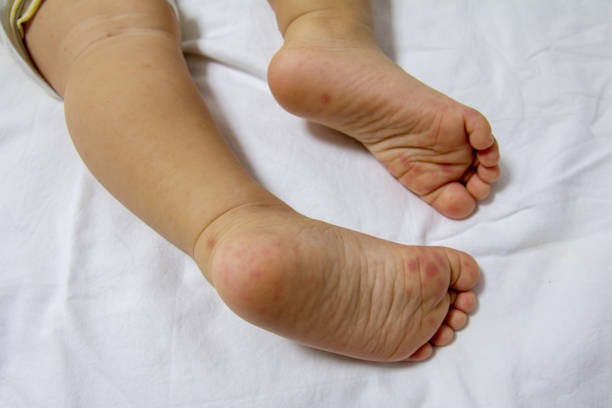 istock Hand Foot and Mouth disease 1222585791